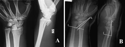 Results Of The Kapandji Procedure In The Ao Type C Distal Radius