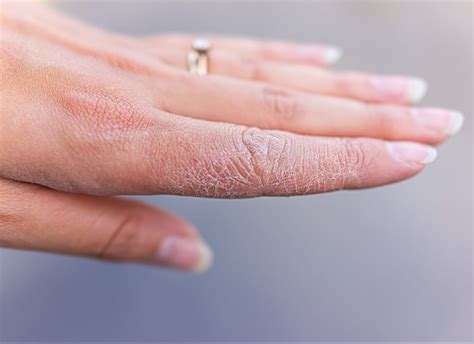 Dyshidrotic Eczema Finger Tips At Helen Breen Blog