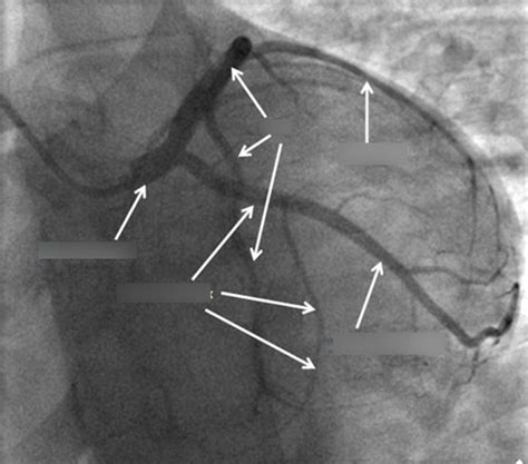 Diagram Of Coronary Angiography Quizlet