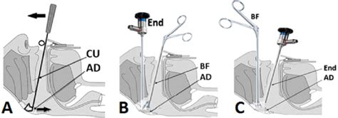 A Adenoidectomy Ad Using The Curette Cu B Endoscopic Download