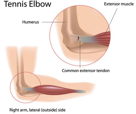 How To Avoid Surgery For Tennis Elbow With Stem Cell Therapy