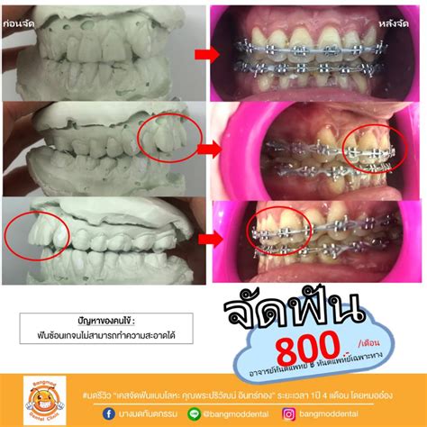 รีวิวจัดฟัน Bangmod Dental Clinic บางมดทันตกรรม