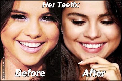 The 411 Dirt Did You Know Selena Gomez Has Veneers 2019