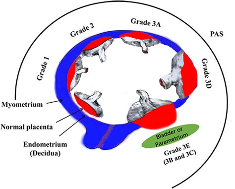 Pas Diagnosis Challenges And Controversies In Obstetrics Ijwh