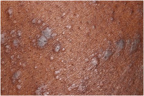 Dermatology Images Lichen Planus Journal Of The American Academy Of Dermatology