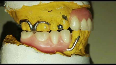 Articulado en estructuras de cromo cobalto PRÓTESIS DENTAL YouTube