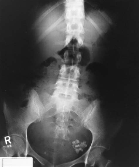 Abdominal Flat Plate X Ray Film Showing Teeth In The Left Side Of The