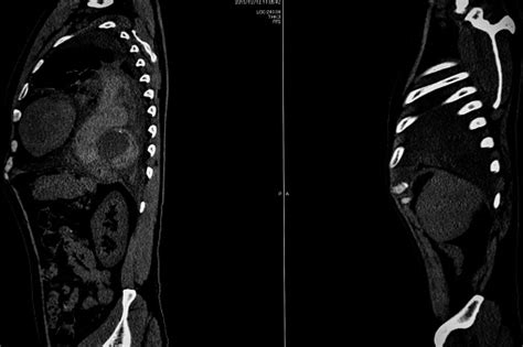 Computer Tomography Angiography Cta Of Whole Body Scan With 3d Reconstruction Ct Angiography For