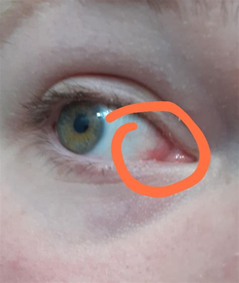 What is this redness in the corner of my eye? : r/optometry