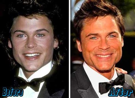 Rob Lowe Plastic Surgery Before And After Photos