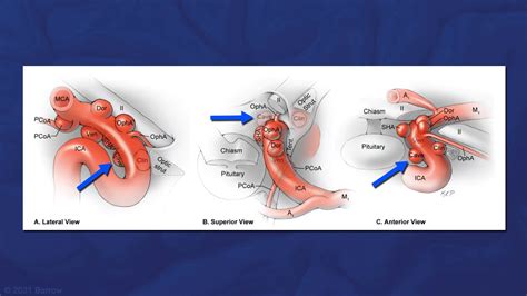 Microsurgical Clipping Of Paraclinoid Internal Carotid Artery ICA