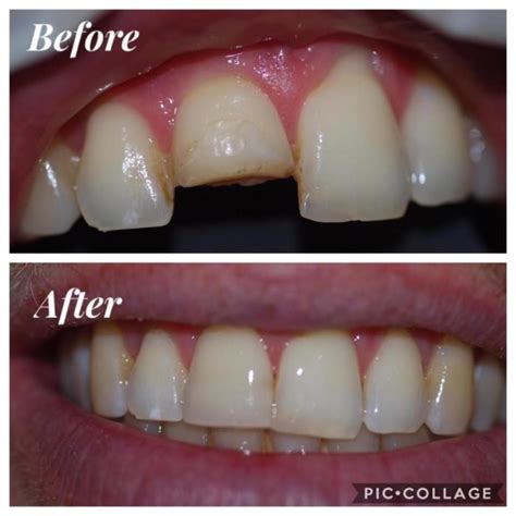 Composite Tooth Coloured Fillings ForteDent Dental Clinic Sliema