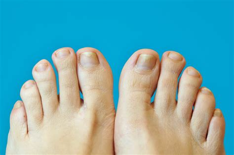 Psoriasis Sur Le Pied Causes Rem Des Photo Que Faire