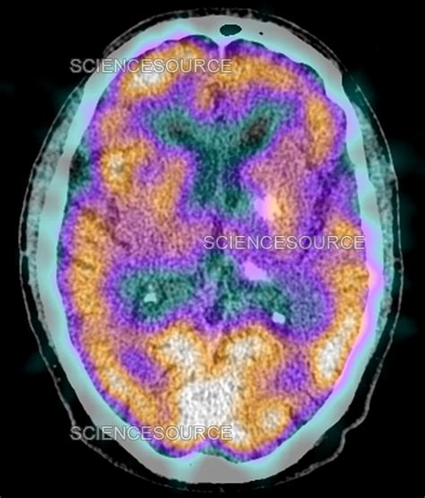 Photograph Normal Brain Spect Ct Scan Science Source Images