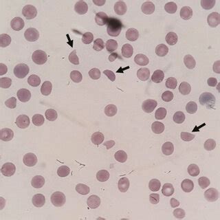 Peripheral blood smear examination revealing numerous schistocytes ...