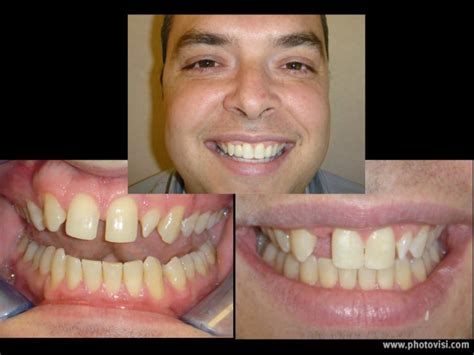 Invisalign Before And After Gallery Advanced Dental Care Quincy Il