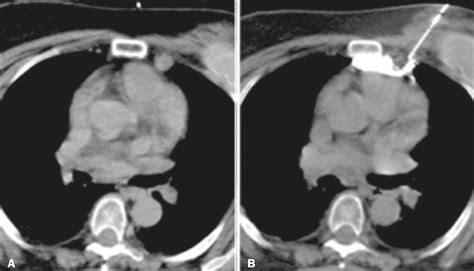 Scielo Brasil Modified Hydrodissection For Computed Tomography Guided Biopsy Of Mediastinal