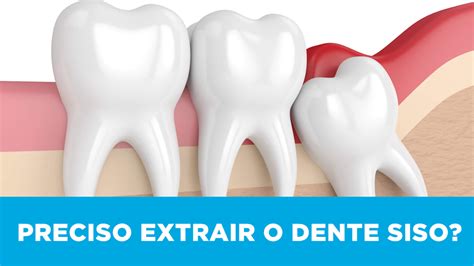 Como Saber Se Preciso Extrair O Dente Siso Sorrix