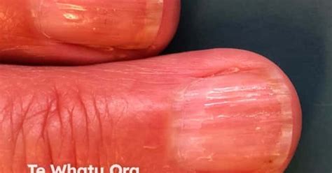 Dermnet Nail Dystrophy Due To Lichen Planus Image