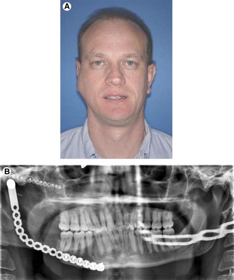 Customized Repair Of Fractured Mandibular Reconstruction Plates