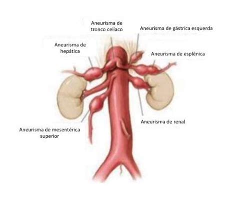 Aneurismas Viscerais E Perif Ricos Sbacvsp