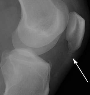 Sinding Larsen Johansson Syndrome Physiopedia