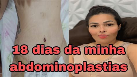 18 DIAS PÓS ABDOMINOPLASTIA contei tudo YouTube