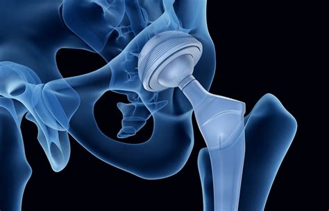 Total Hip Arthroplasty Revision Rate Examined From To