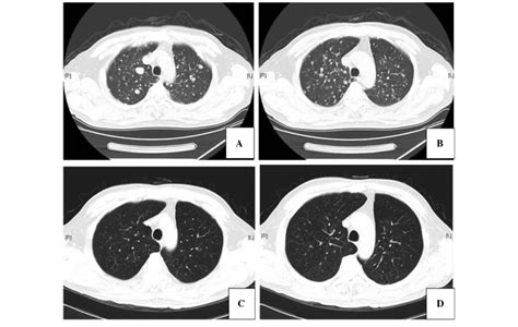 Axial Chest Computed Tomography Ct Scans A And B Scans Prior To