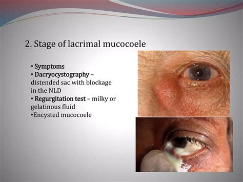 Chronic Dacryocystitis Ppt