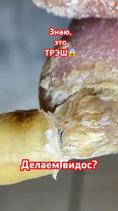 Онихогрифоз / грибок ногтей / толстый ноготь - YouTube