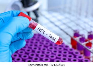 Hdl Test Look Abnormalities Blood Blood Stock Photo 2240551001