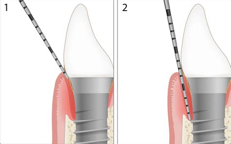 Periodontal Chart Online Perio Tools