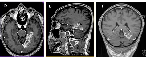 Pca Infarction Radiology Cases