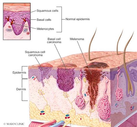 Basal cell carcinoma-Basal cell carcinoma - Symptoms & causes - Mayo ...