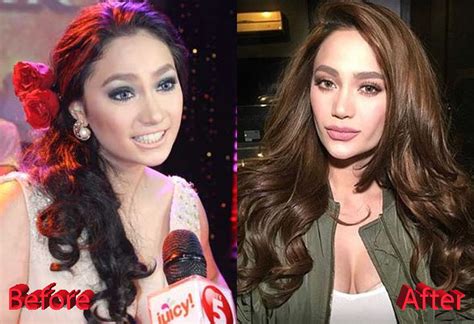 Arci Munoz Before and After Plastic Surgery