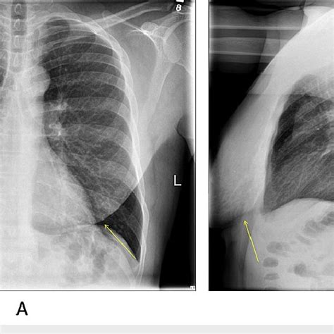 Frontal A And Lateral B Chest Radiographs Show Bilateral Symmetric