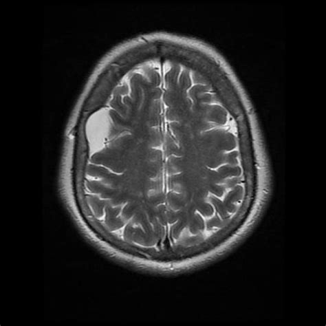 Arachnoid Cyst Frontal Image