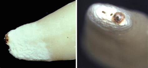 Conventional Laser Endodontics Pocket Dentistry