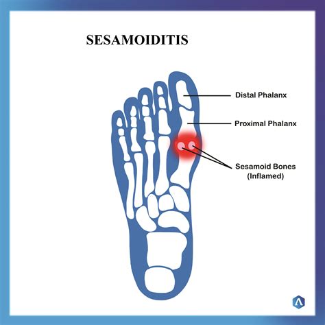 Sesamoiditis Dr Abbie Clinics