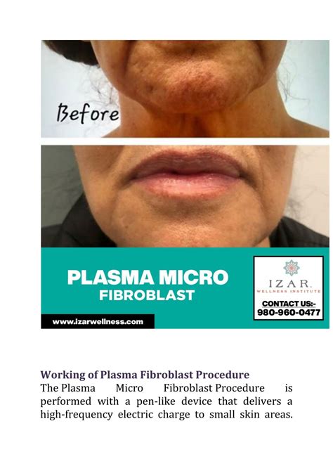 Ppt Plasma Micro Fibroblast Procedure For Skin Tightening Powerpoint