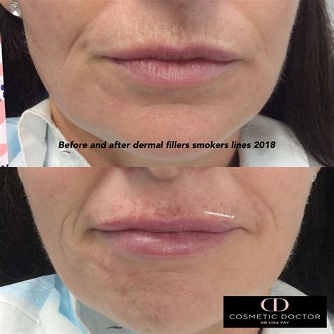 Smokers Lips Before And After Lipstutorial Org