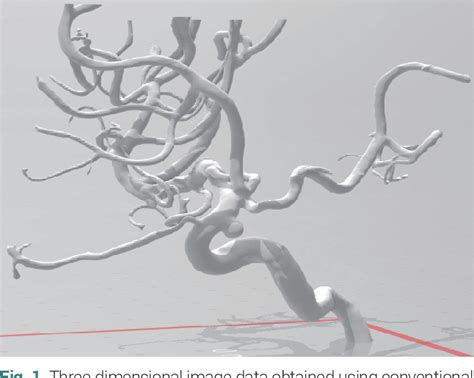 Pdf Optimal Microcatheter Shaping Method Customized For A Patient