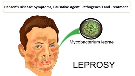 Mycobacterium Leprae Microbiology Notes