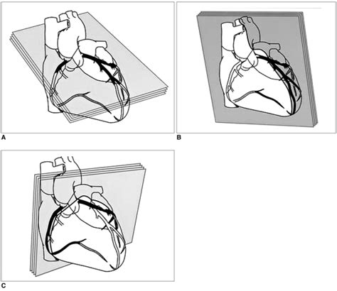 Schematic Diagram Of The Range Of Parallel Thin Slab Maximum Intensity