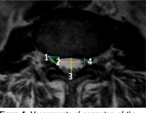 Figure From Morphometric Study Of Lumbar Spine In Nepalese Adult