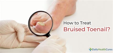 Bruised Toenail: Causes, Types, Home Remedies, and Healing Time