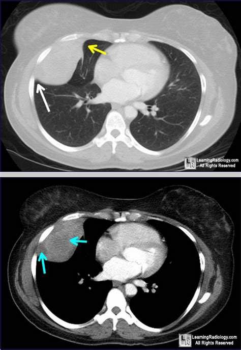 Localized Fibrous Tumor Of The Pleura Upper Photo Large Pleural