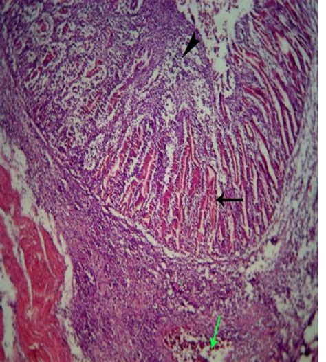 Proventriculus of (MD) showing mucosal infiltration by intense ...