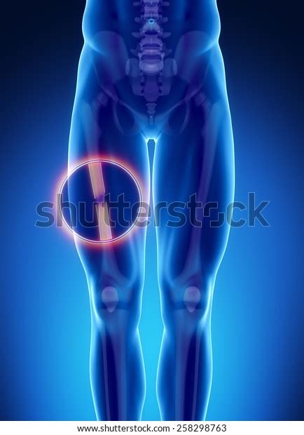 Femur Fracture In A Person Stock Photos - 1,493 Images | Shutterstock